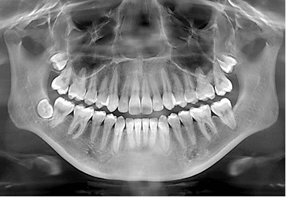 Custom-fitted sports mouthguard for contact sport