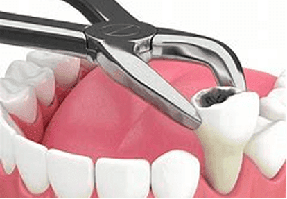Custom take-home teeth whitening bleaching trays